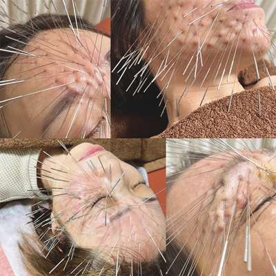顔面部への鍼治療